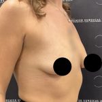 Breast Augmentation Before & After Patient #2587