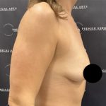 Breast Augmentation Before & After Patient #2587