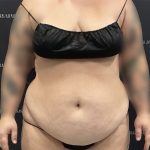 Mini Tummy Tuck Before & After Patient #2594