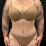 Mini Tummy Tuck Before & After Patient #2594