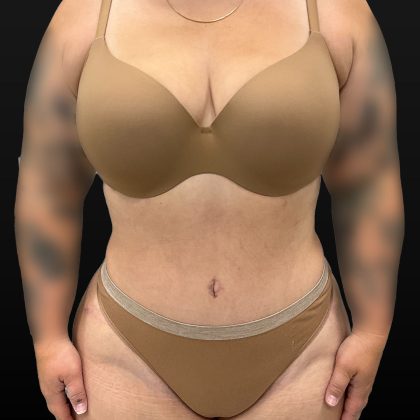 Mini Tummy Tuck Before & After Patient #2594