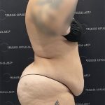 Mini Tummy Tuck Before & After Patient #2594