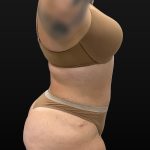 Mini Tummy Tuck Before & After Patient #2594