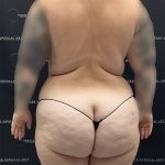 Mini Tummy Tuck Before & After Patient #2594