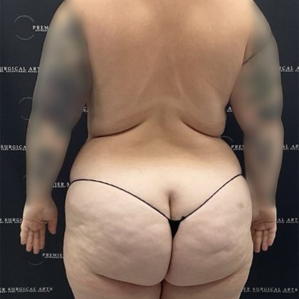 Mini Tummy Tuck Before & After Patient #2594