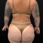 Mini Tummy Tuck Before & After Patient #2594