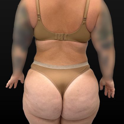 Mini Tummy Tuck Before & After Patient #2594