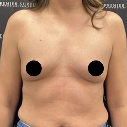Breast Augmentation Before & After Patient #2608