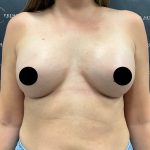 Breast Augmentation Before & After Patient #2608