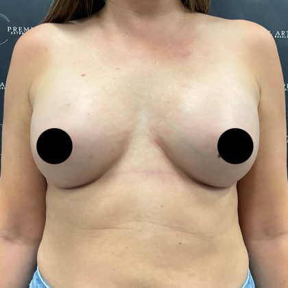 Breast Augmentation Before & After Patient #2608