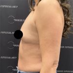 Breast Augmentation Before & After Patient #2608