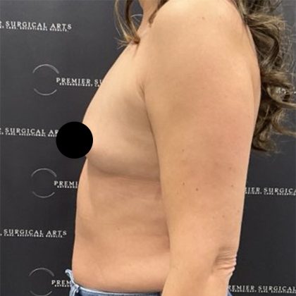 Breast Augmentation Before & After Patient #2608