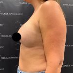 Breast Augmentation Before & After Patient #2608