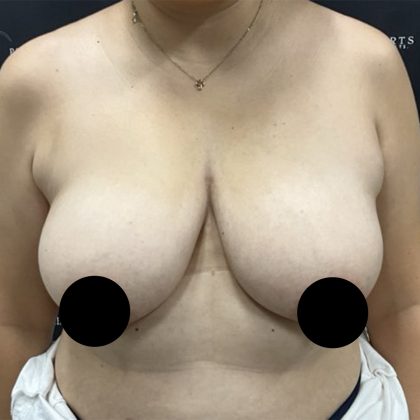 Breast Lift Before & After Patient #2609