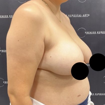 Breast Lift Before & After Patient #2609