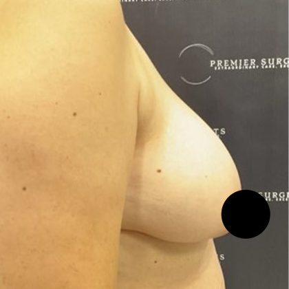 Breast Lift Before & After Patient #2609