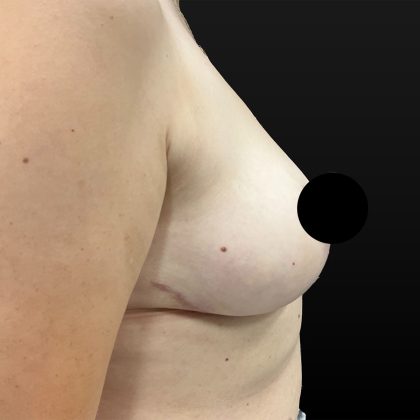 Breast Lift Before & After Patient #2609