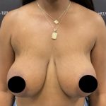 Breast Augmentation + Lift Before & After Patient #2629