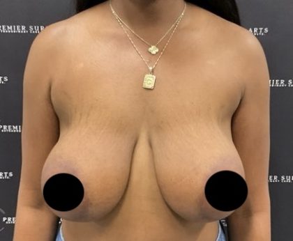 Breast Augmentation + Lift Before & After Patient #2629