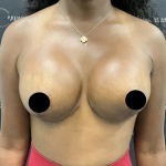 Breast Augmentation + Lift Before & After Patient #2629