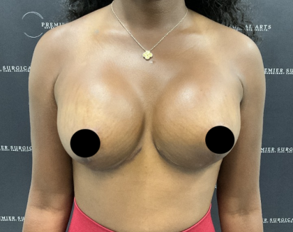 Breast Augmentation + Lift Before & After Patient #2629