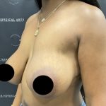 Breast Augmentation + Lift Before & After Patient #2629
