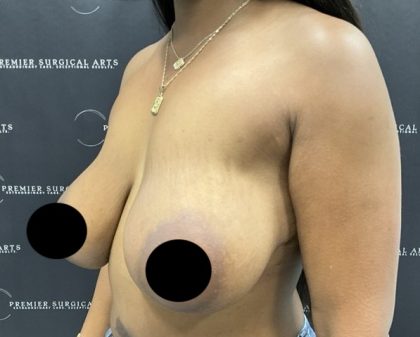 Breast Augmentation + Lift Before & After Patient #2629