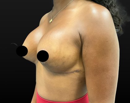 Breast Augmentation + Lift Before & After Patient #2629