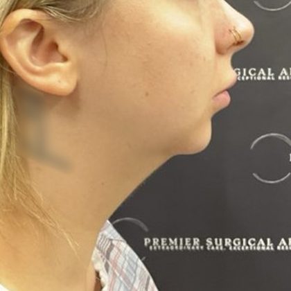 Non-surgical Skin Tightening Before & After Patient #2655