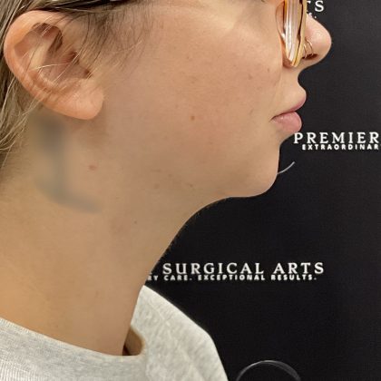 Non-surgical Skin Tightening Before & After Patient #2655
